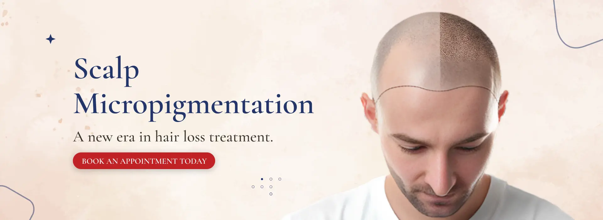 Scalp Micropigmentation (2)