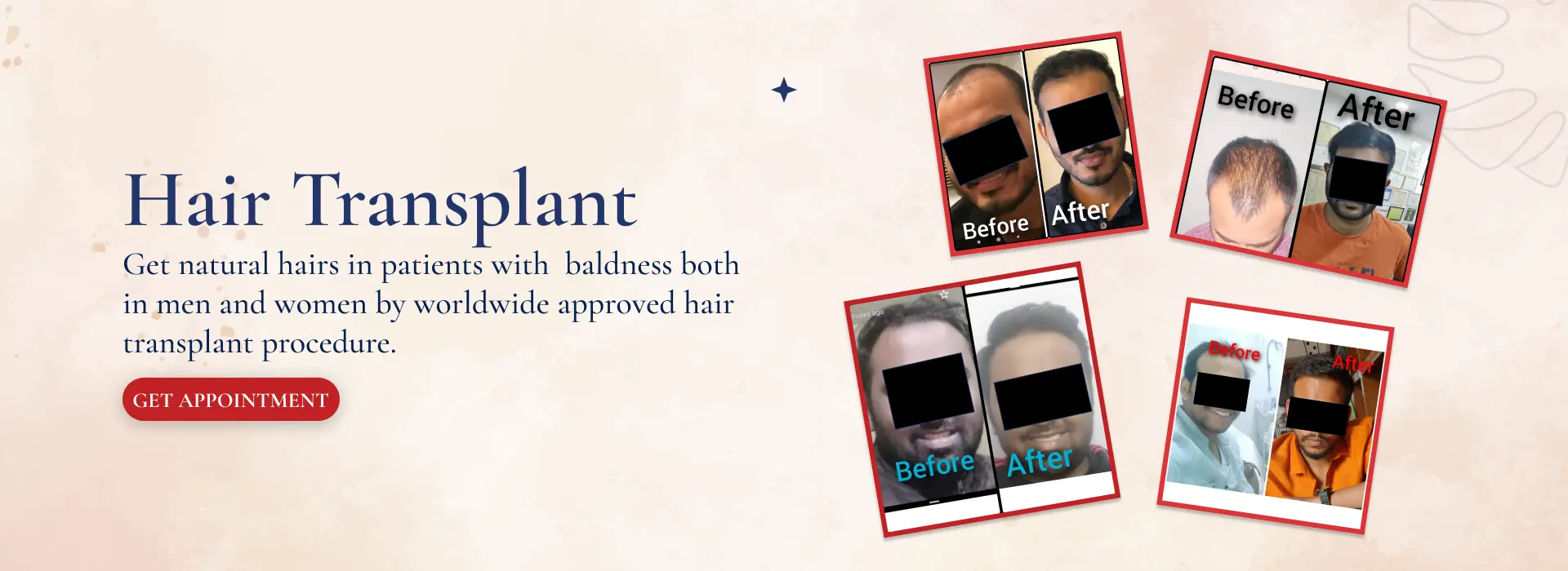 hair transplant (15)